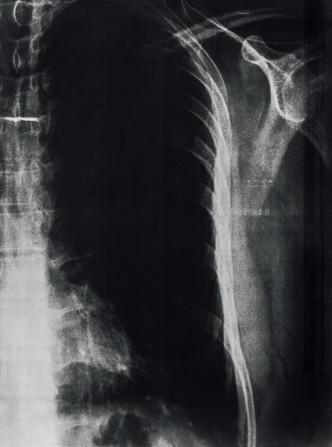 Imagen 6. El dolor de la existencia en imagen de lo real.Radiografía digital. (Autor, 2022).